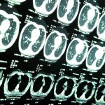 Traumatic Brain Injury (TBI) Stats from the CDC