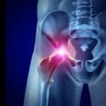 DePuy faces several personal injury lawsuits