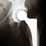 All-metal hip devices fail at a higher rate than traditional materials, like plastic and ceramic