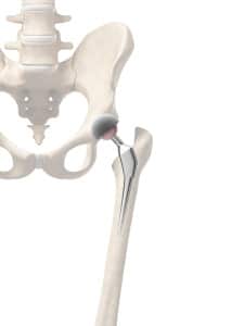 Further hip-replacement lawsuits against DePuy