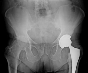 DePuy Orthopedics Hip Lawsuit